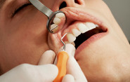 SITA: Ako má prebiehať dentálna hygiena? Slováci sa často nechajú oklamať, tvrdia odborníci